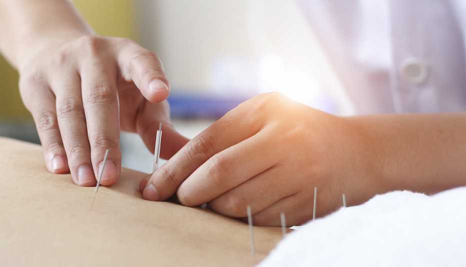 Acupuncture being applied to the back