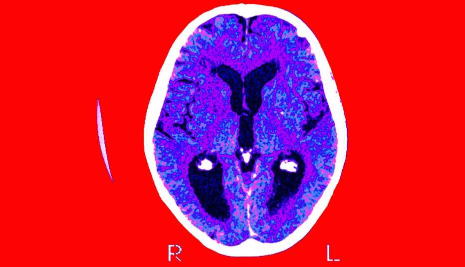 scan of a brain that is showing signs of alzheimers disease