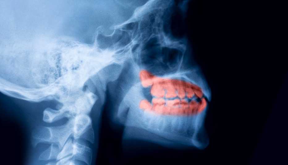 Decayed Tooth Pain On X-Ray
