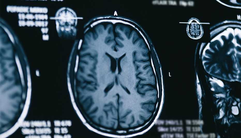 Imagen del cerebro