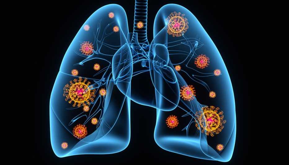Ilustración de unos pulmones infectados con el coronavirus
