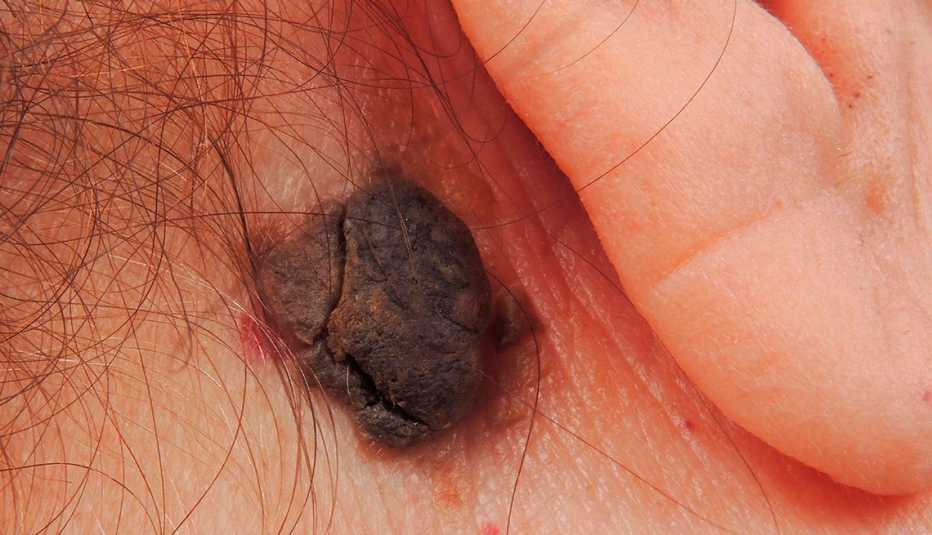 Queratosis seborreica: una verruga oscura o un crecimiento parecido a un lunar detrás de la oreja.