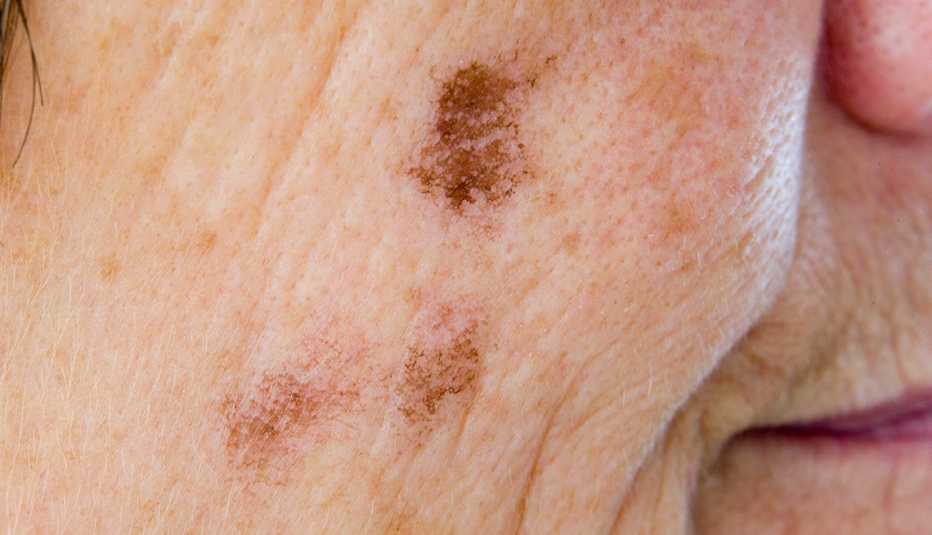 Lentigo Senilis o manchas hepáticas en el rostro de una mujer.