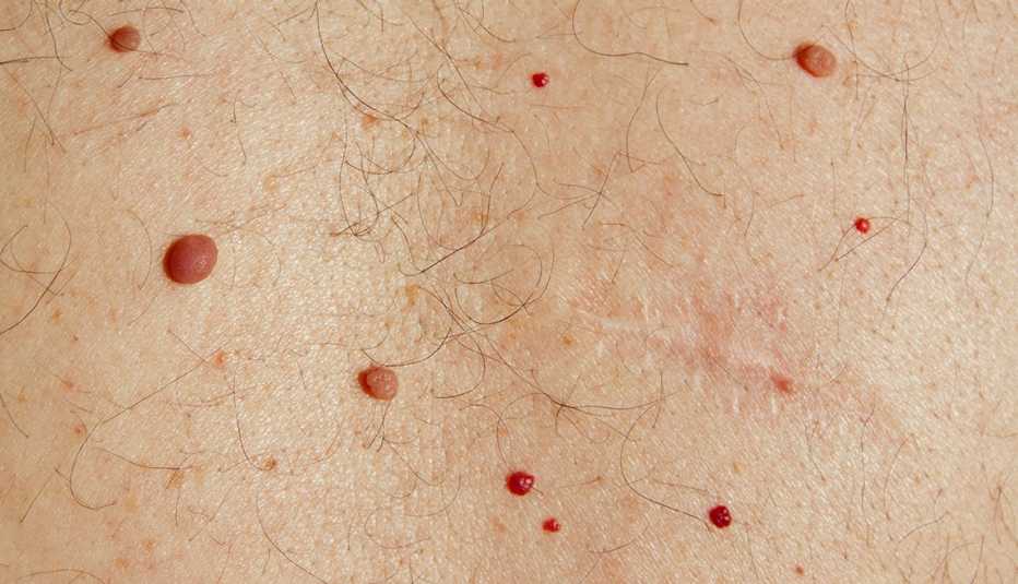La espalda de un hombre mayor con lunares, quistes, angiomas color cereza y pecas. Más una cicatriz por la extirpación de un quiste.