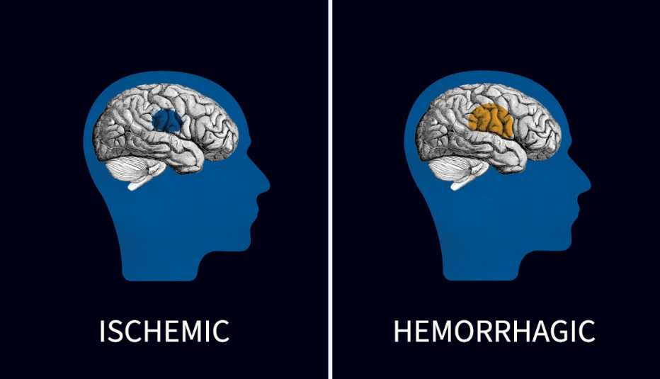 Una ilustración que representa los dos tipos de accidente cerebrovascular.
