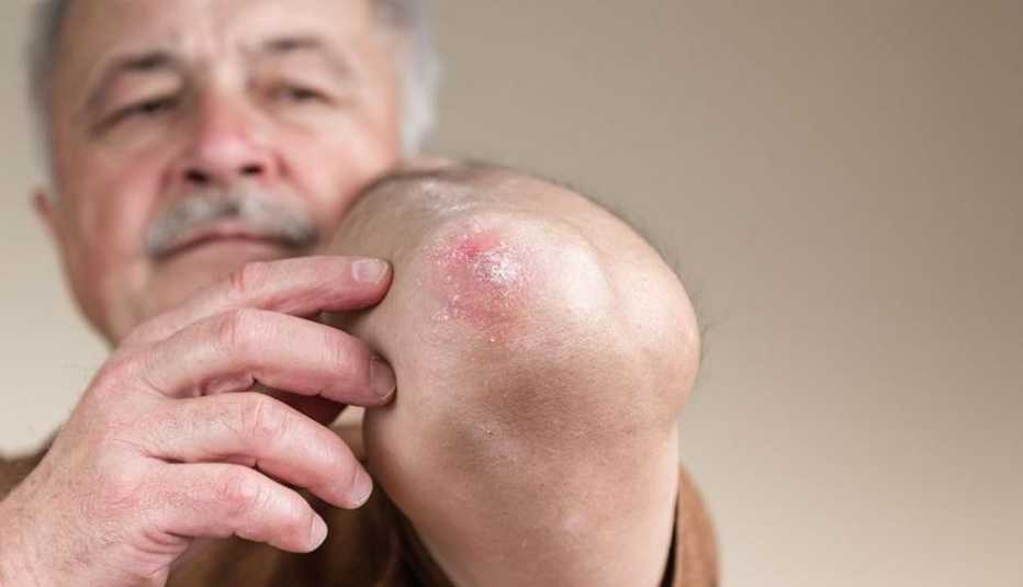 Un hombre muestra su codo escamado por la psoriasis