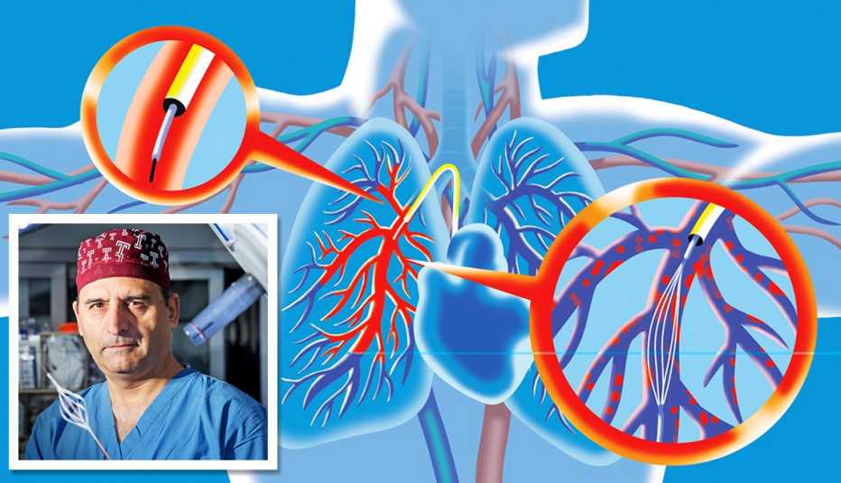 Este catéter desbloquea las arterias a la vez que administra medicamentos para disolver los coágulos. Recuadro: El inventor de dispositivos, el Dr. Riyaz Bashir