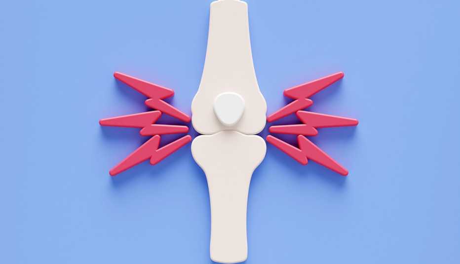 Ilustración conceptual de la artritis reumatoide