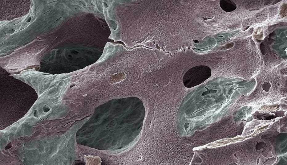 Imagen de un hueso humano con daños - Síntomas de la falta de carbohidratos en la dieta 